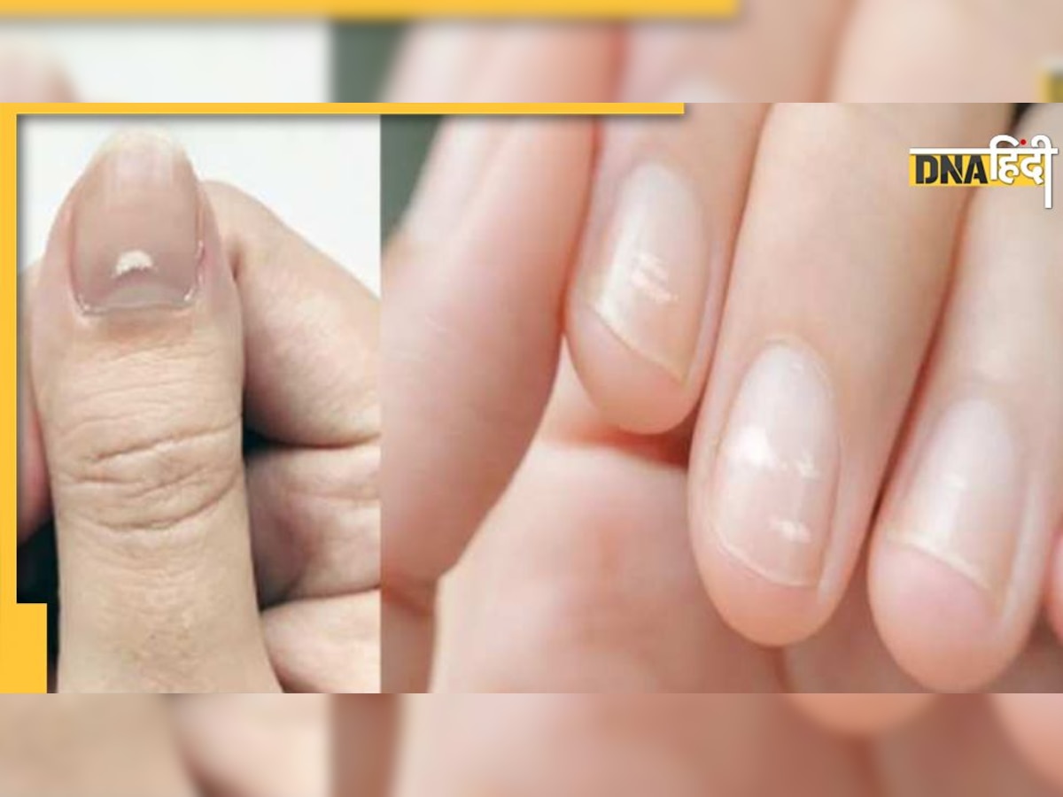 White Spots On Nails: नाखूनों पर दिखने वाले काले-सफेद निशान भी देते है शुभ-अशुभ का संकेत, जानिए कब दाग होते हैं अच्छे