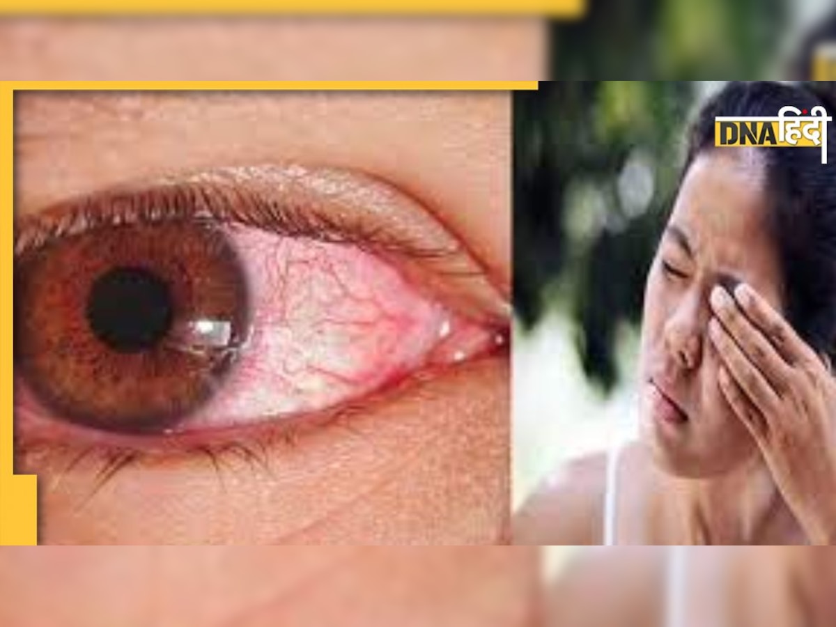 Eye Care Tips: सुबह उठने पर दिखती हैं आंखें लाल? सूजन और लाली खत्म करने के जान लें ये घरेलू नुस्खे