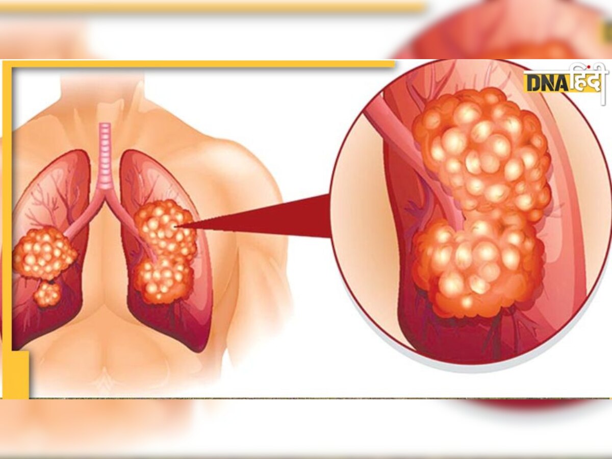 Fatty lungs: फेफड़ों में फैट जमा होने पर दिखते है ये गंभीर लक्षण, ज्यादा वेट वाले रहें सावधान