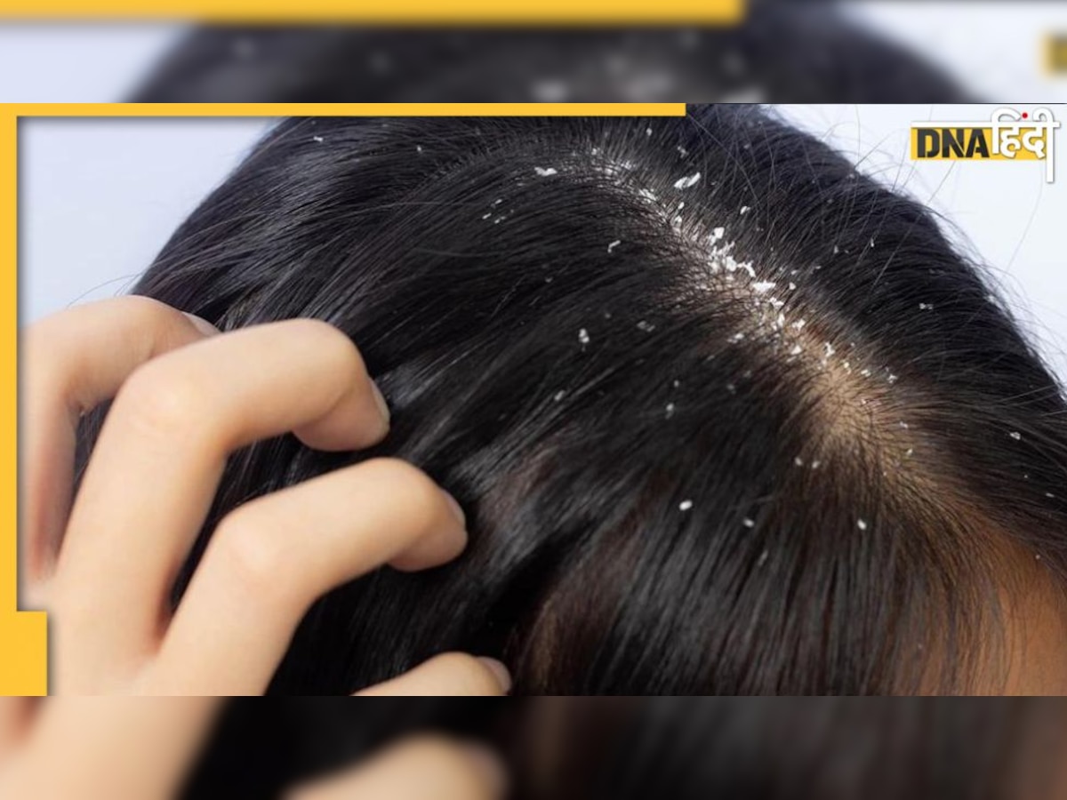 Dandruff Remedy: बालों में खुजली और डैंड्रफ से हैं परेशान तो ये टिप्स एंड ट्रिक्स आएंगे काम, बालों का झड़ना भी रुकेगा