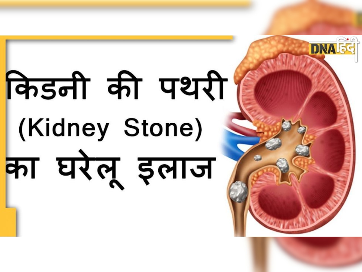 kidney Stone Remedy: खाली पेट पी लें ये रस किडनी में फंसा स्टोन आ जाएगा बाहर, दर्द भी होगा कम