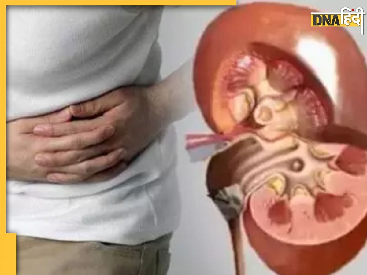 Kidney Stone: गलती से भी इन फूड्स के साथ न खाएं नमक, यूरिन में कैल्शियम बढ़ने से हो सकता है किडनी में स्टोन