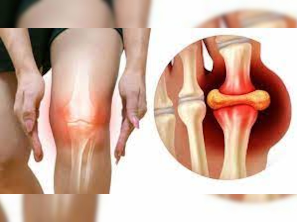 Arthritis Symptoms: पैर के अगूठे में दिख रहा ये संकेत बताता है शरीर में बढ़ रहा यूरिक एसिड, जान लें आर्थराइटिस के प्रारंभिक लक्षण