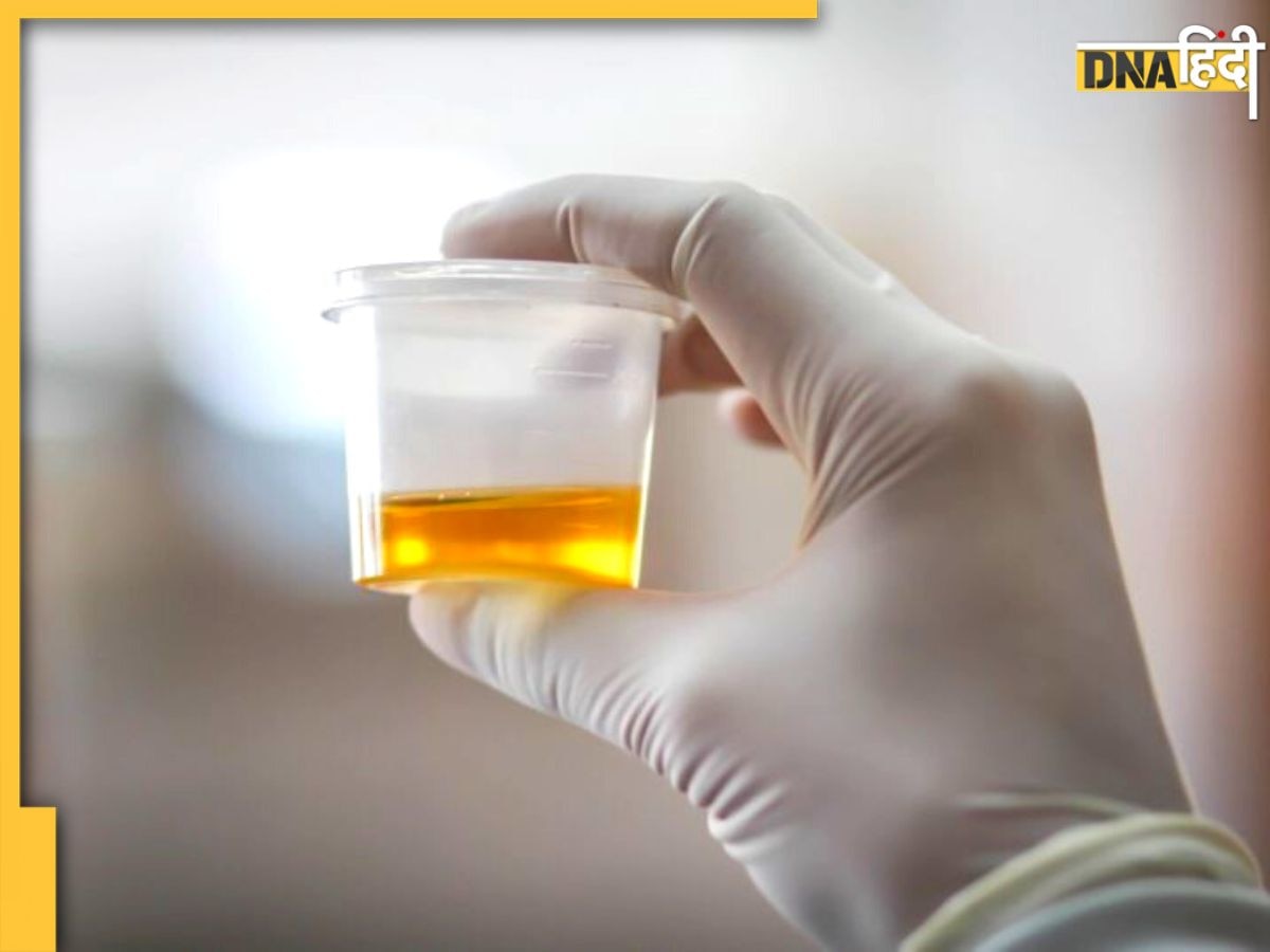 Urine Colour Sign: यूरिन का रंग बता देगा शरीर में पल रही कौन सी बीमारी, पेशाब का झागदार होना भी खतरे का संकेत