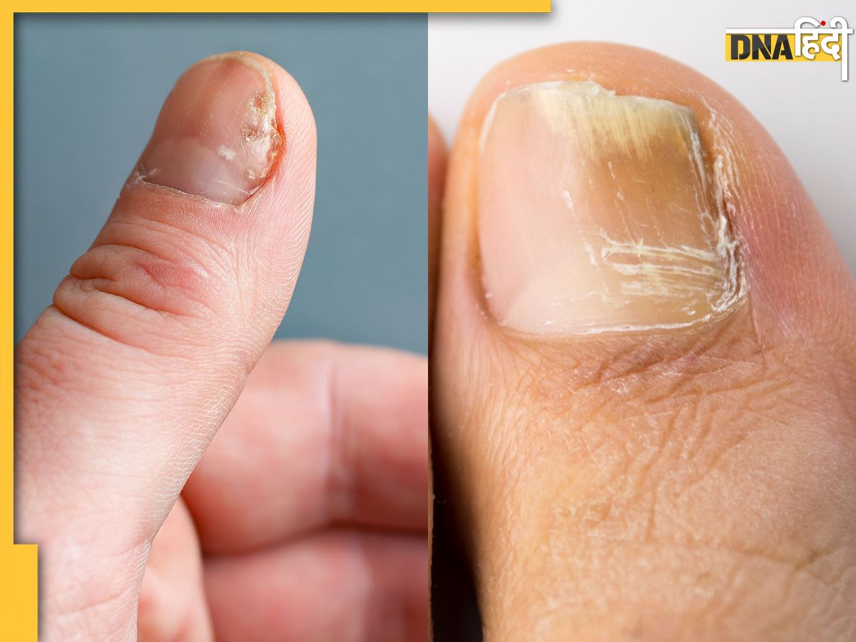 Nails White Spots: नाखून पर सफेद स्पॉट्स क्या किसी बीमारी के होते हैं  संकेत? - Why White Spots Appear On Nails Know Causes