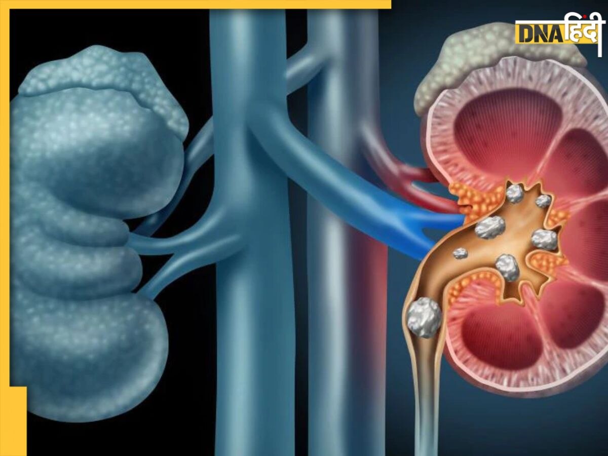 Kidney Stones: बिना ऑपरेशन पथरी को गलाकर बाहर निकाल देंगी ये 5 चीजें, जान लें ये असरदार तरीका 