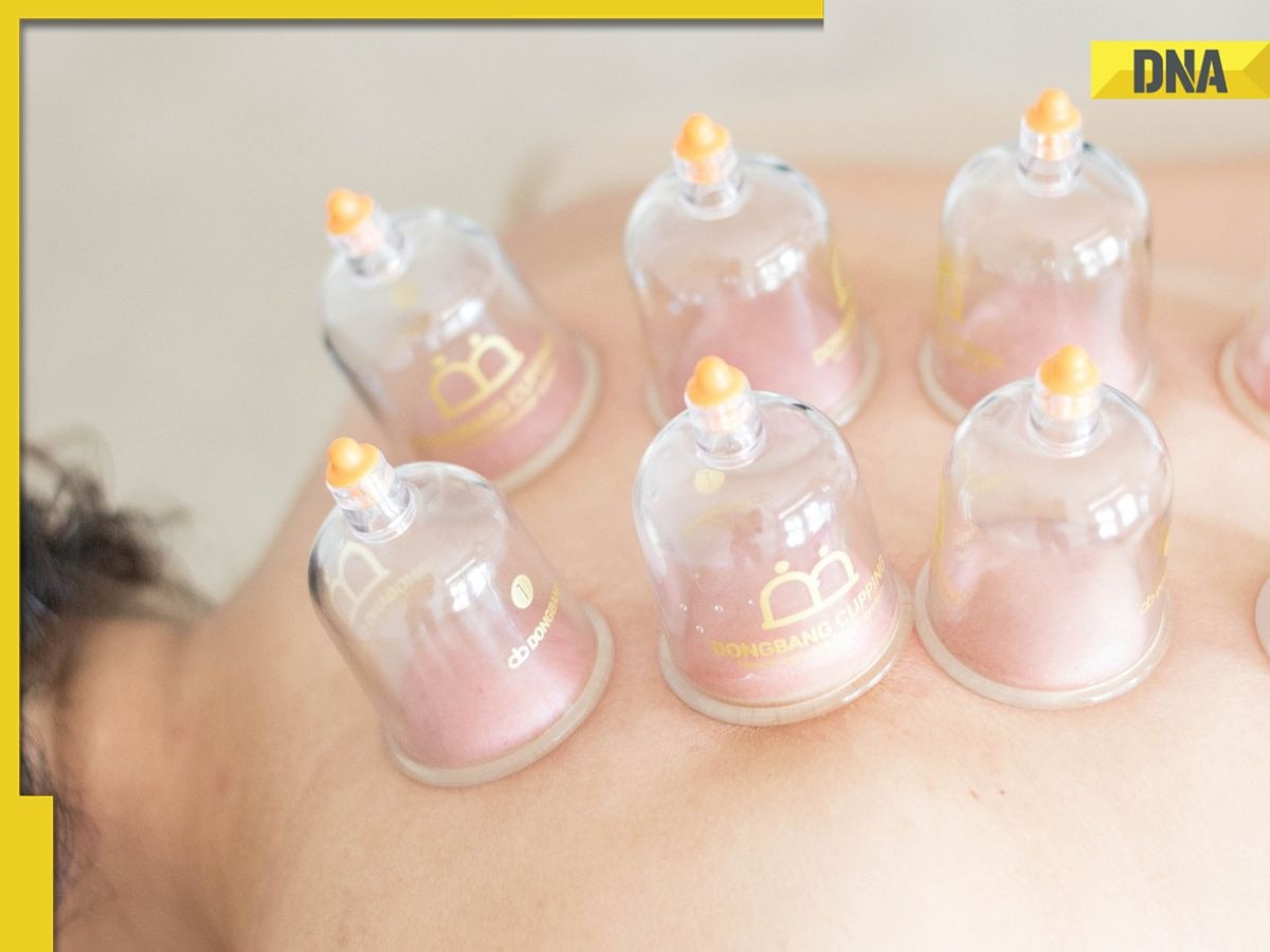 What is 'Hijama', cupping therapy hugely popular in Dubai, Saudi Arabia and other Muslim nations?