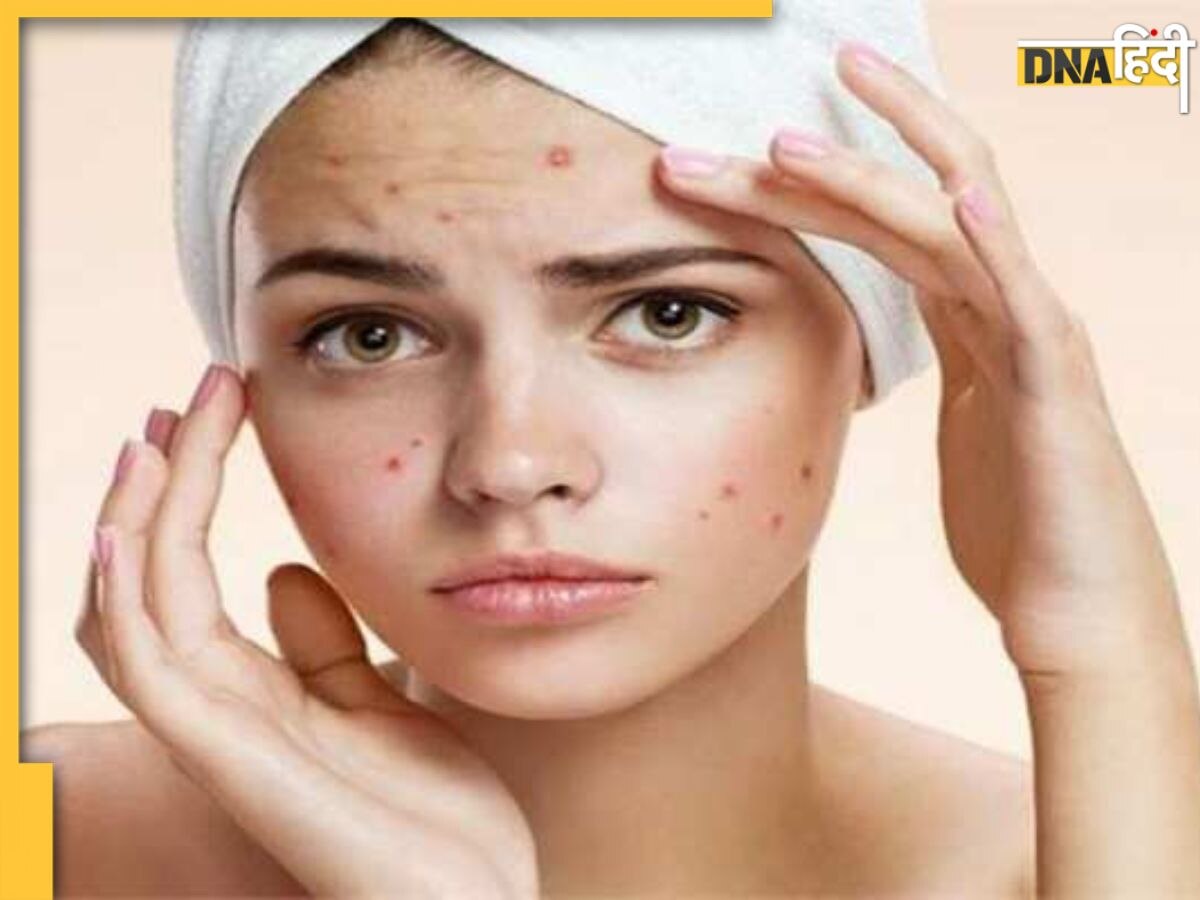 Pimples Remedy: ये 5 चीजें हफ्ते भर में गायब कर देंगी पिंपल्स-मुहांसे, सूजन और रेडनेस भी होगा दूर