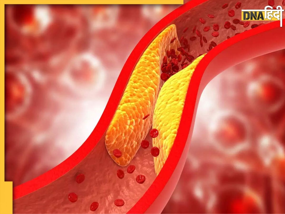 Reduce High Cholesterol: मात्र ढाई रुपये से नसों में जमा कोलेस्ट्रॉल पिघलकर आ जाएगा बाहर, हेल्दी रहेगा दिल