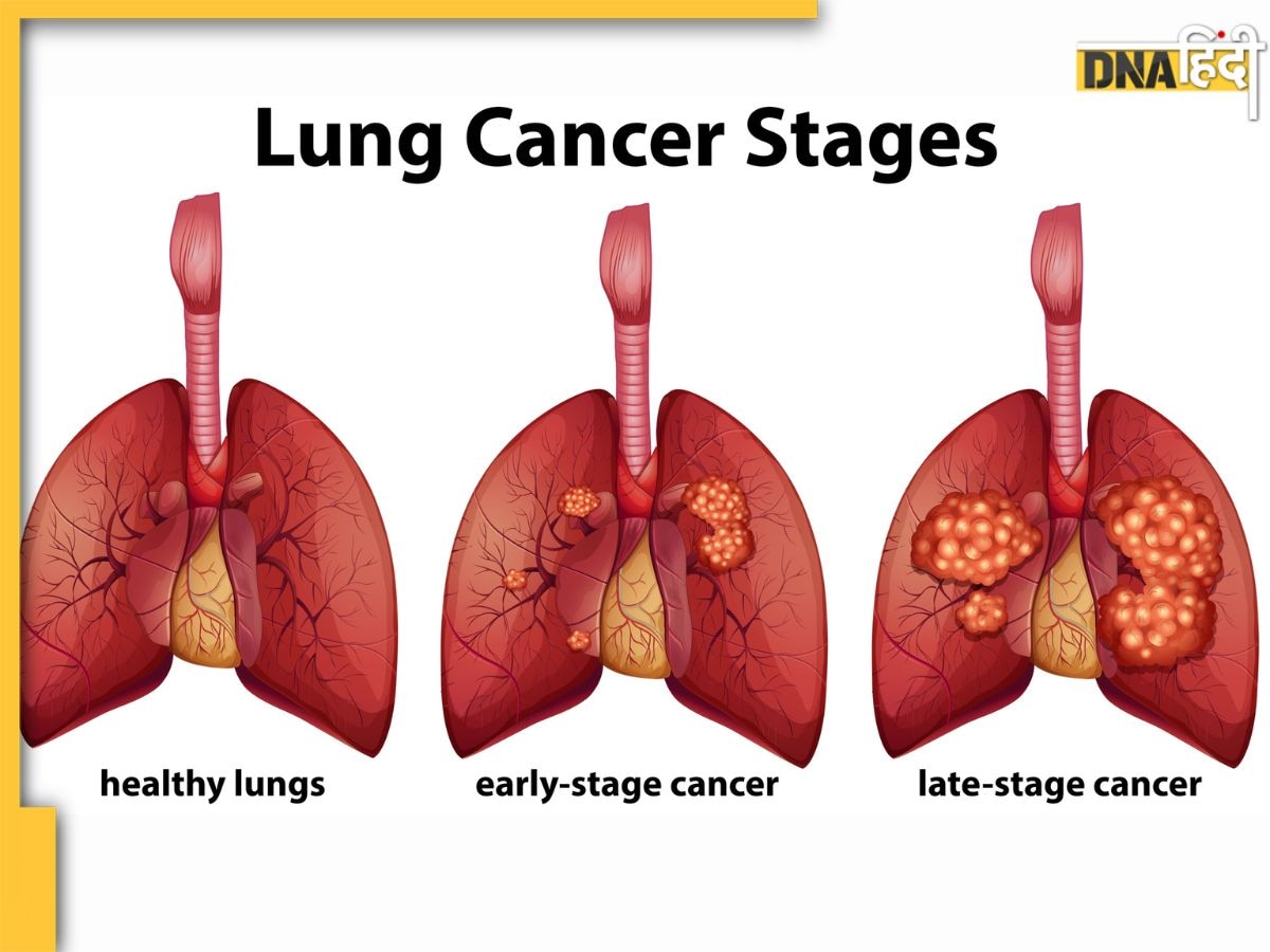 Lung Cancer: फेफड़ों को गला देती हैं ये 3 चीजें, लंग्स कैंसर से बचा सकते हैं ये 5 उपाय