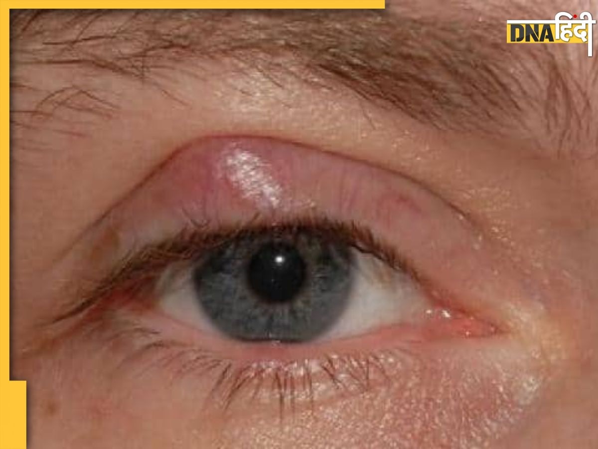 Lumps on Eyelids: हल्के में न पलकों पर होने वाली गांठ, चेलाज़ियन जैसी बीमारी का है ये संकेत, जान लें लक्षण और इलाज