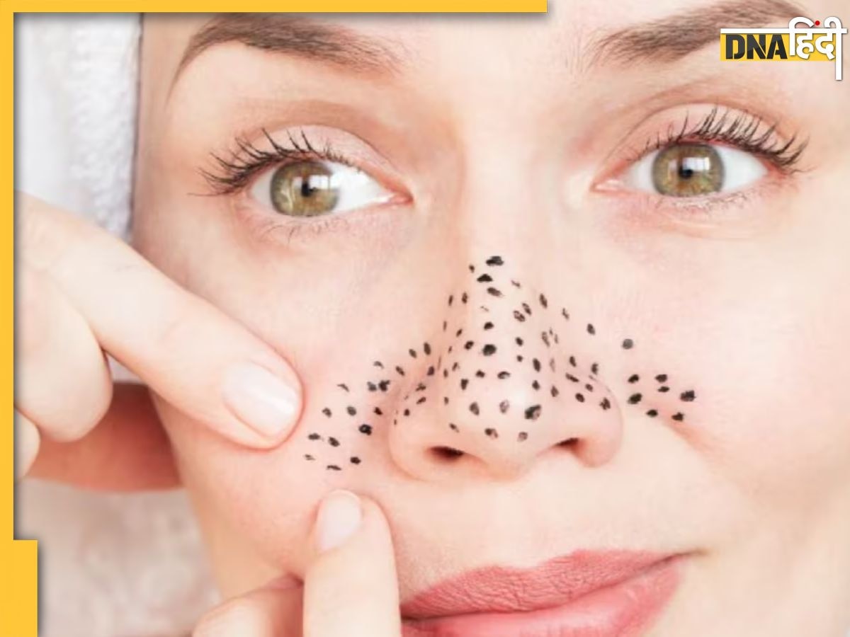 Blackheads Treatment: चेहरे पर जम गए हैं ब्लैकहेड्स तो अजमाएं ये घरेलू उपाय, चमक उठेगी स्किन