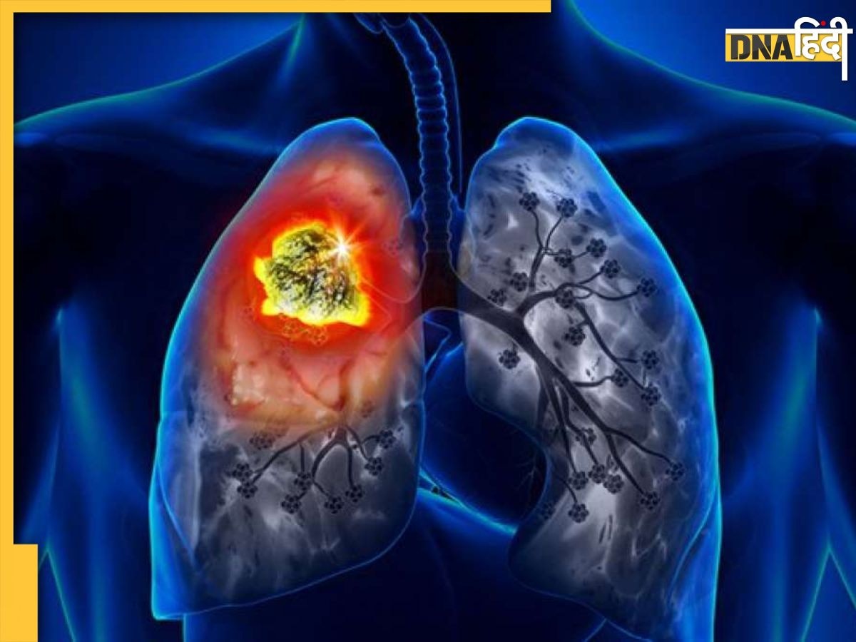 Lungs Cancer Symptoms: शरीर में दिखें ये 5 लक्षण तो तुरंत हो जाए सतर्क, लंग्स कैंसर के हो सकते हैं संकेत