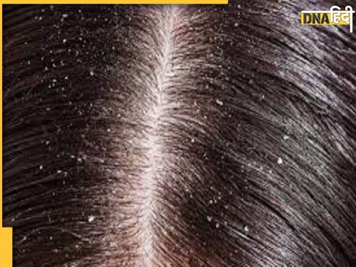 Hair Care Tips: डैंड्रफ से हैं परेशान तो इन 5 बातों को रखें ध्यान, हमेशा के लिए खत्म हो जाएगी ये समस्या