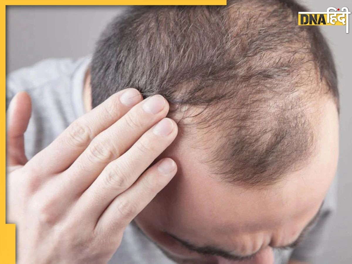 Hair Fall Remedy: तेजी से हो रहा Hair Fall तो इस तेल से स्कैल्प तक करें मसाज, जड़ से मजबूत और घने हो जाएंगे बाल