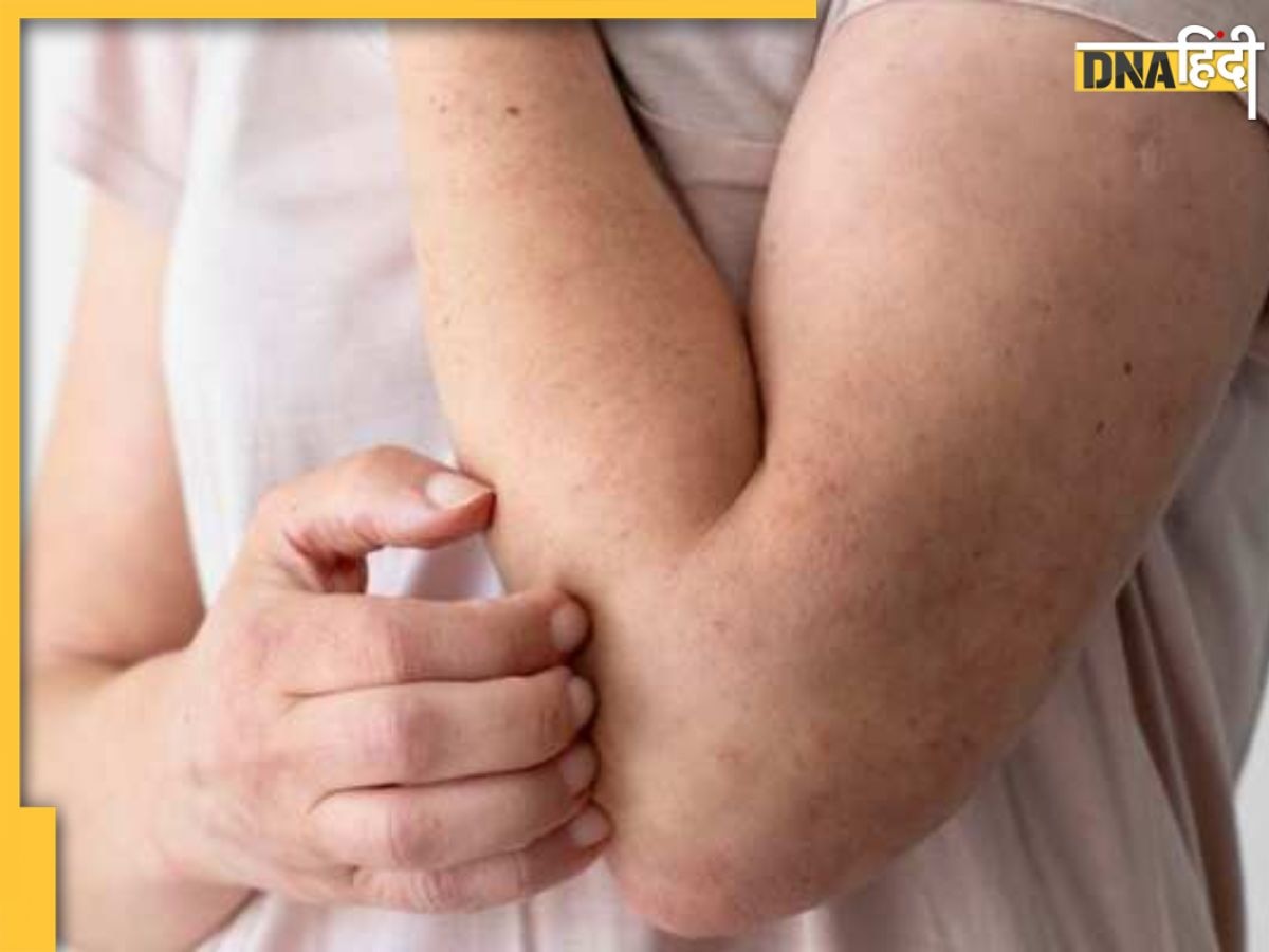 Diabetic Skin की वजह से बढ़ जाती हैं त्वचा से जुड़ी ये गंभीर परेशानियां, जानिए कारण और बचाव का तरीका 