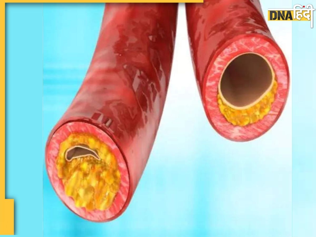 Cholesterol Remedy: नसों में जम गया है बैड कोलेस्ट्रॉल? ये 6 चीजें ब्लड में जमा फैट को मोम की तरह पिघला देंगी