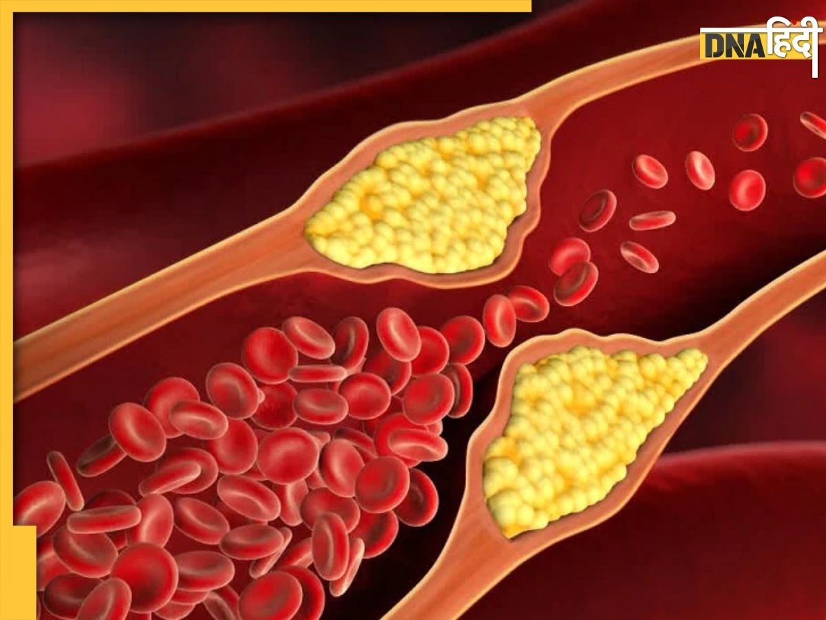 High Cholesterol: खाली पेट नींबू पानी से लेकर खाएं ये 4 चीज, 7 दिनों में हाई से लो लेवल पर आ जाएगा कोलेस्ट्रॉल