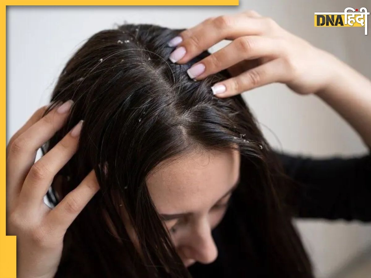 Dandruff Remedies:बालों पर जमी सफेदी जड़ से खत्म कर देंगे ये 3 नुस्खे, स्कैल्प पर जमा डैंड्रफ तक क��ुछ ही घंटों में हो जाएगा साफ