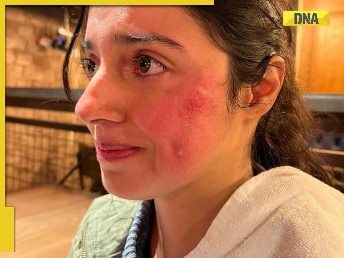 Divya Khosla Kumar gets injured as she crashes into iron grill while shooting, details inside