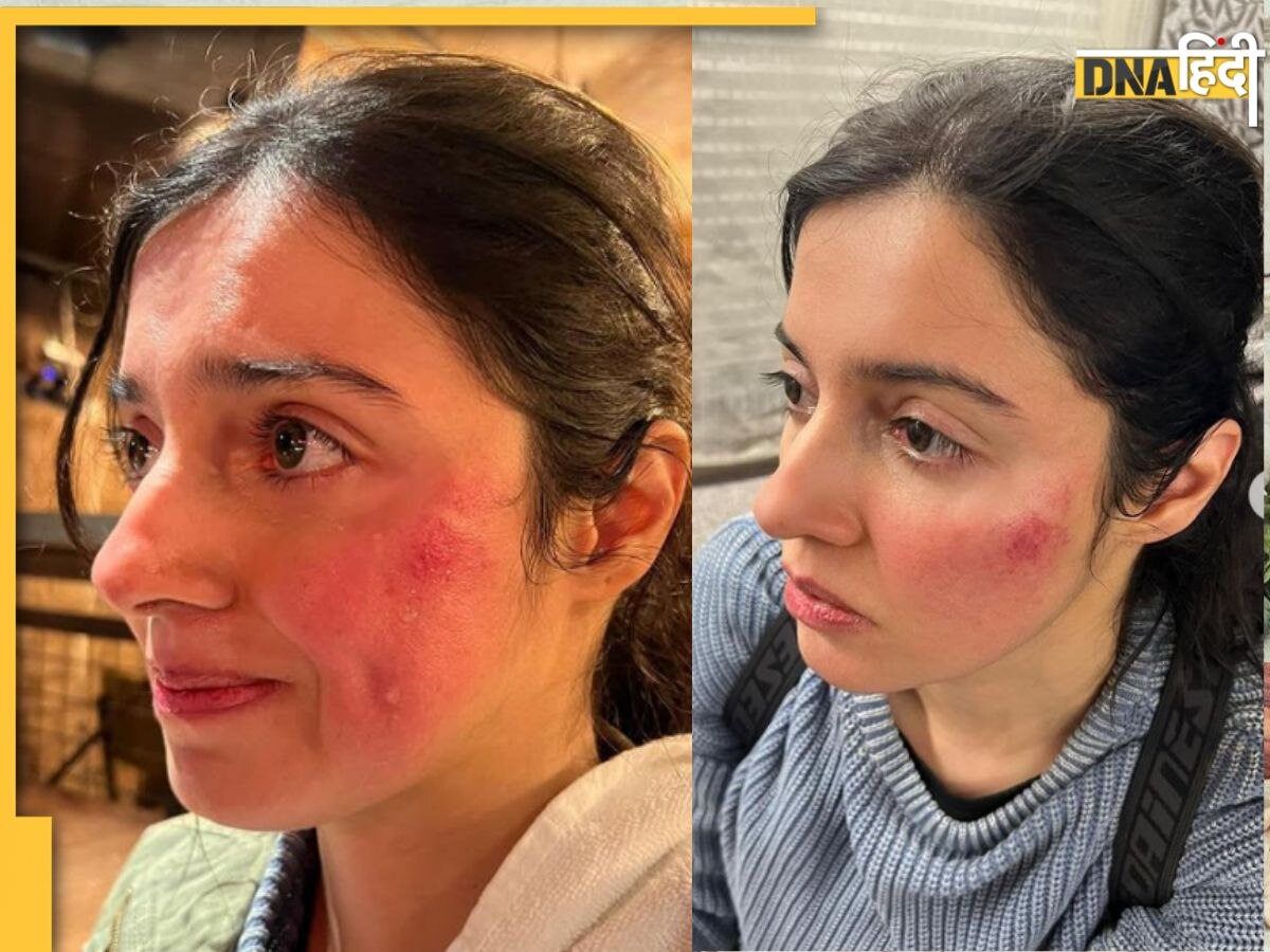 Divya Khosla Injured: शूटिंग के दौरान घायल हुई दिव्या खोसला कुमार, चेहरे पर दिखे गंभीर चोट के निशान