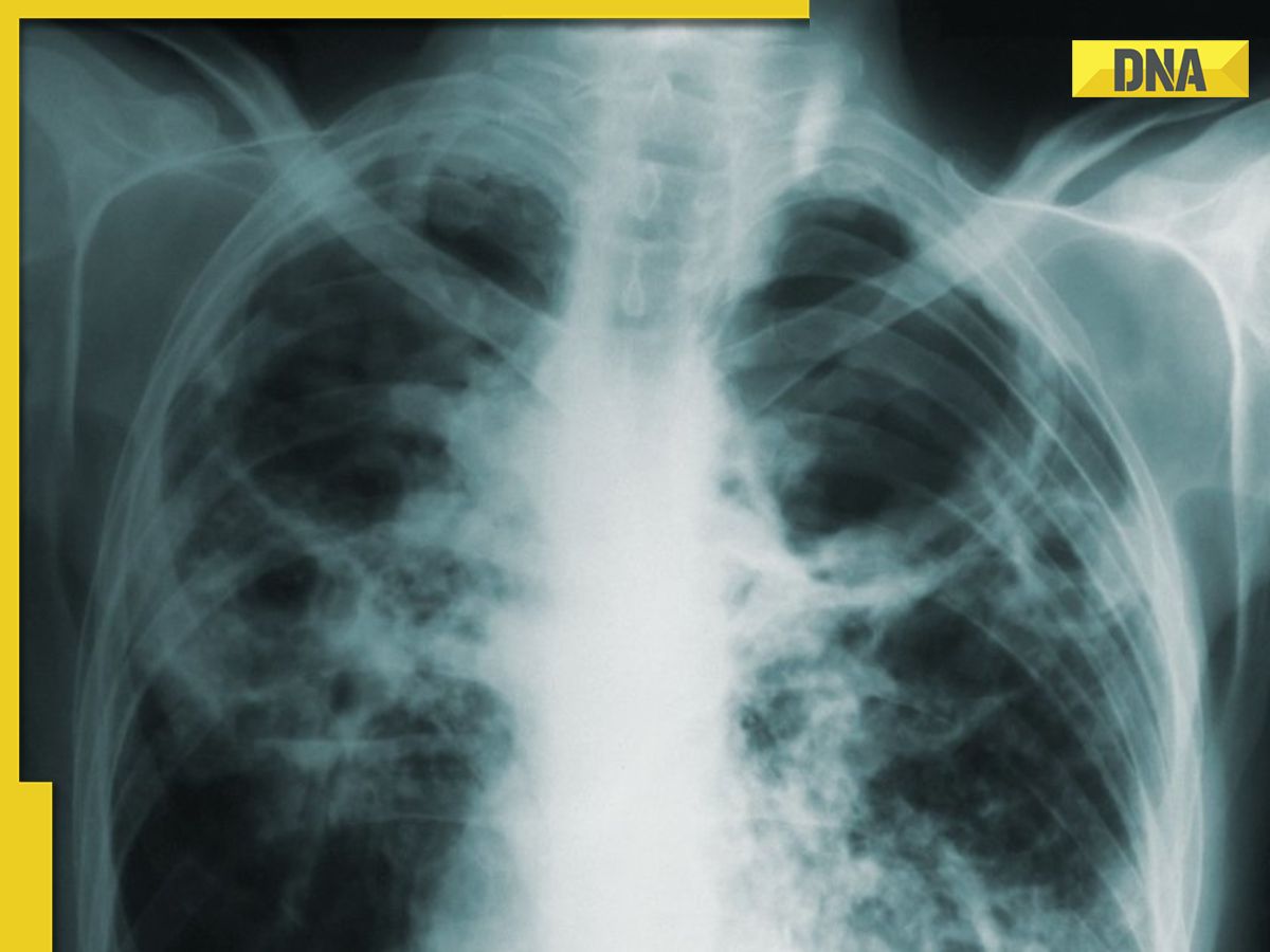World Tuberculosis Day: causes, symptoms and prevention of this deadly