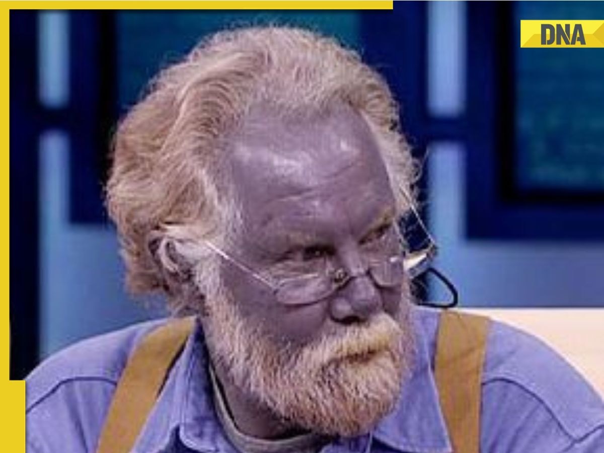 forbandelse Orphan familie What is argyria, a condition that turns skin colour to blue?