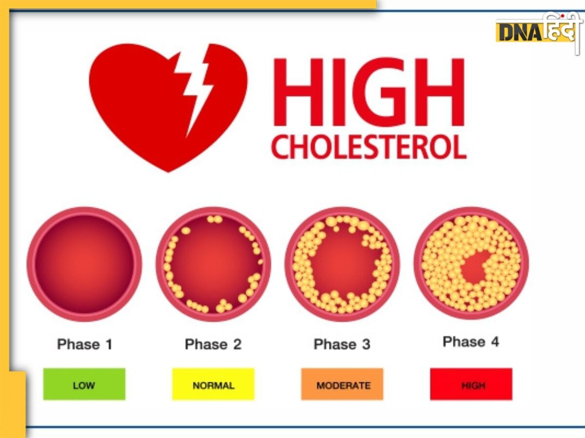 Bad Cholesterol: नसों में जमा गंदा कोलेस्ट्रॉल कम करने का ये है बेस्ट तरीका, खून में जमी वसा तेजी से पिघलने लगेगी