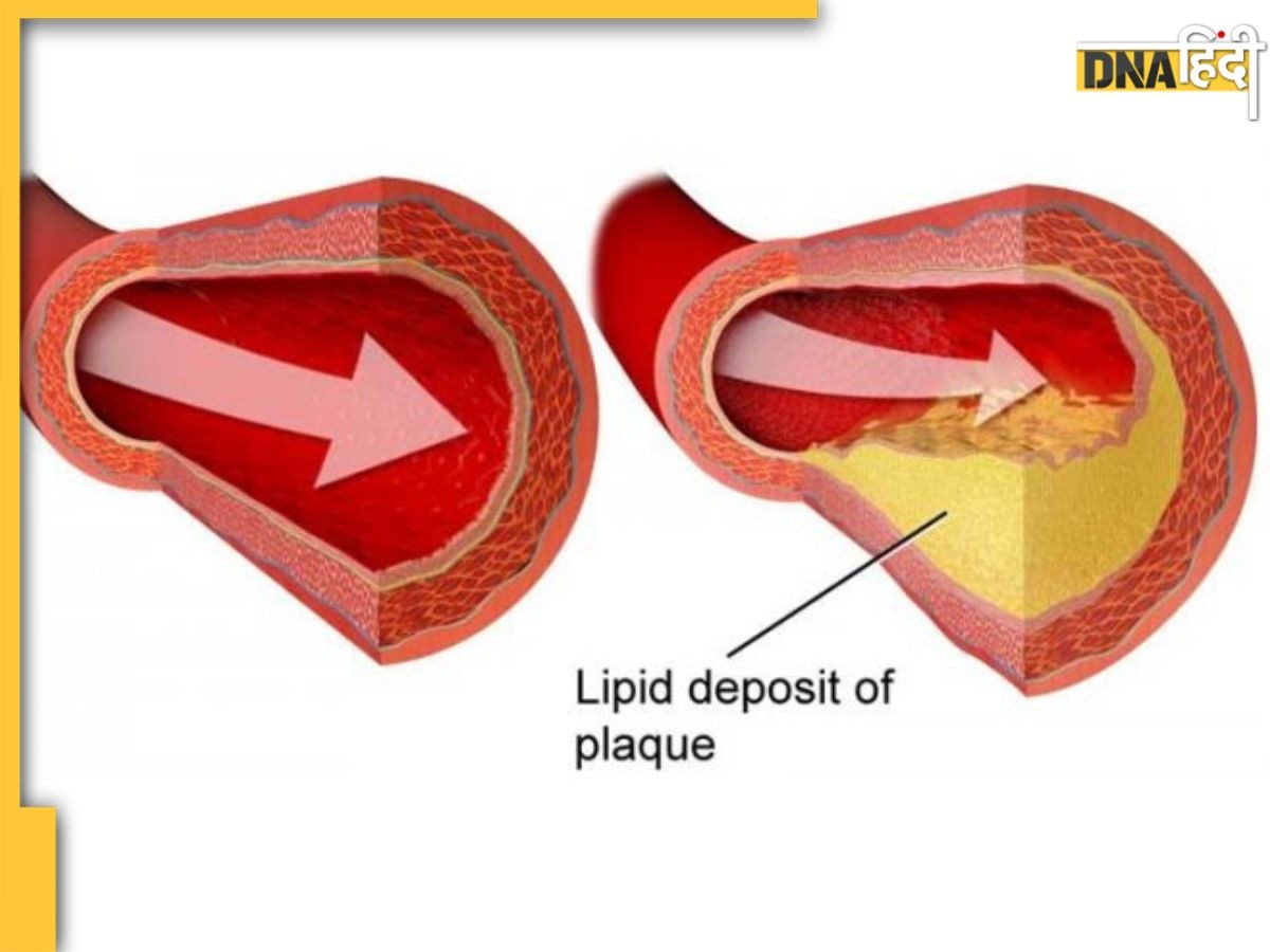 Bad Cholesterol Treatment: खून में गंदा कोले�स्ट्रॉल कभी नहीं होगा जमा, इन 5 तरीकों से नसों में जकड़ी वसा 7 दिनों में गलेगी