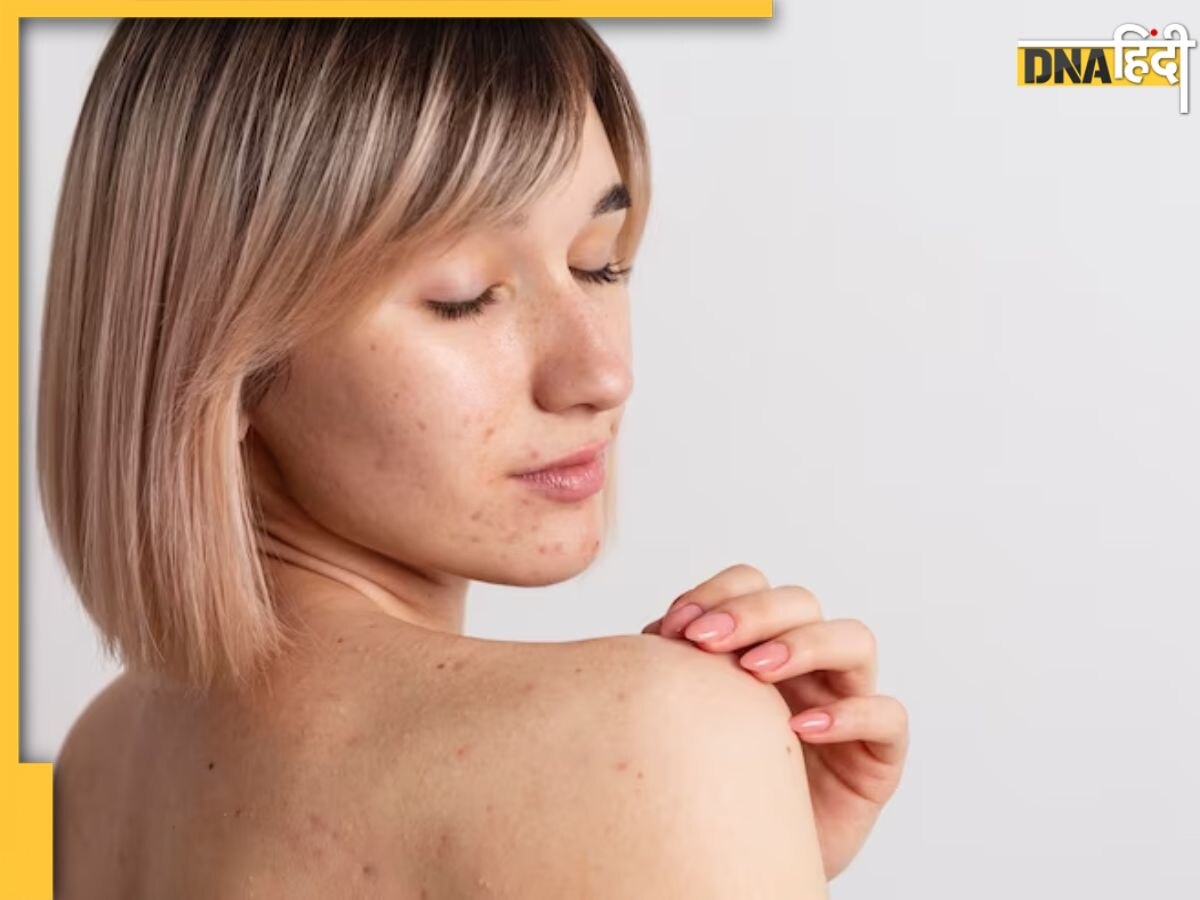 Back Acne Treatment: पीठ पर एक्ने होने की ये है बड़ी वजह, जानिए इनसे डील करने के 6 आसान टिप्स