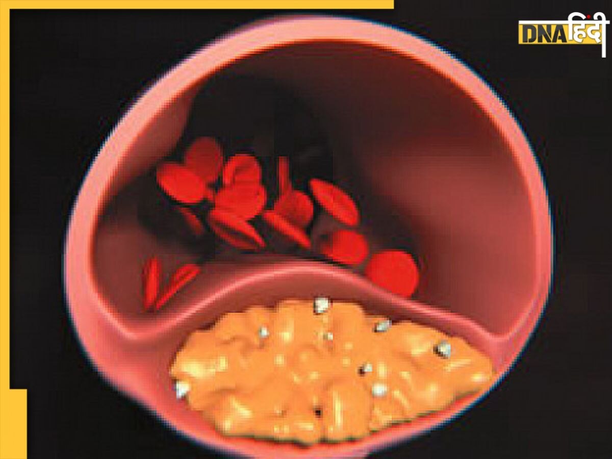 Reduce Cholesterol: नहीं छोड़ीं ये 6 आदतें तो दवा खाकर भी कम नहीं होगा बैड कोलेस्ट्रॉल, नसों की ब्लॉकेज ले लेगी जान