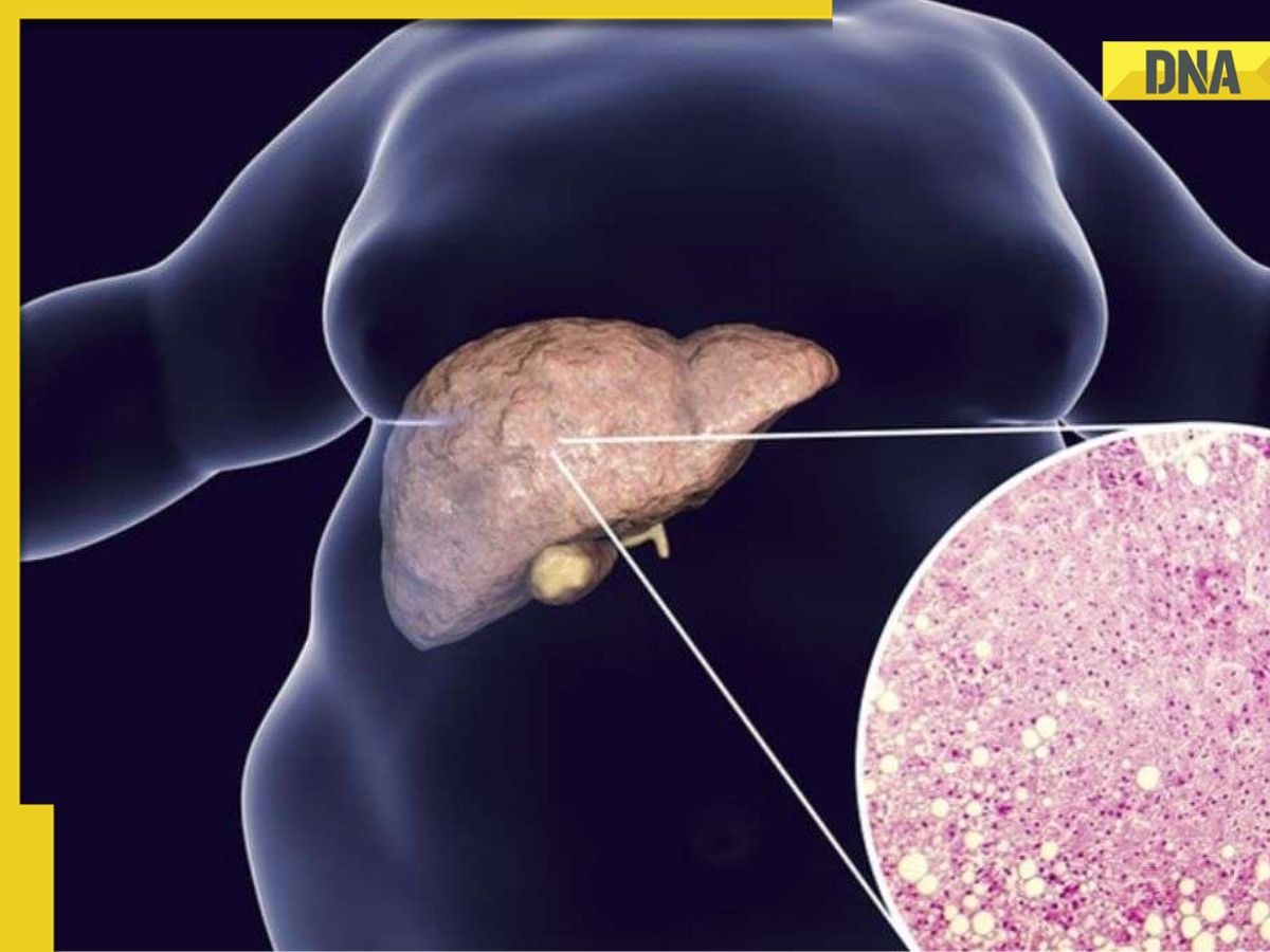 Can fatty liver lead to colon cancer? Here's what new study shows