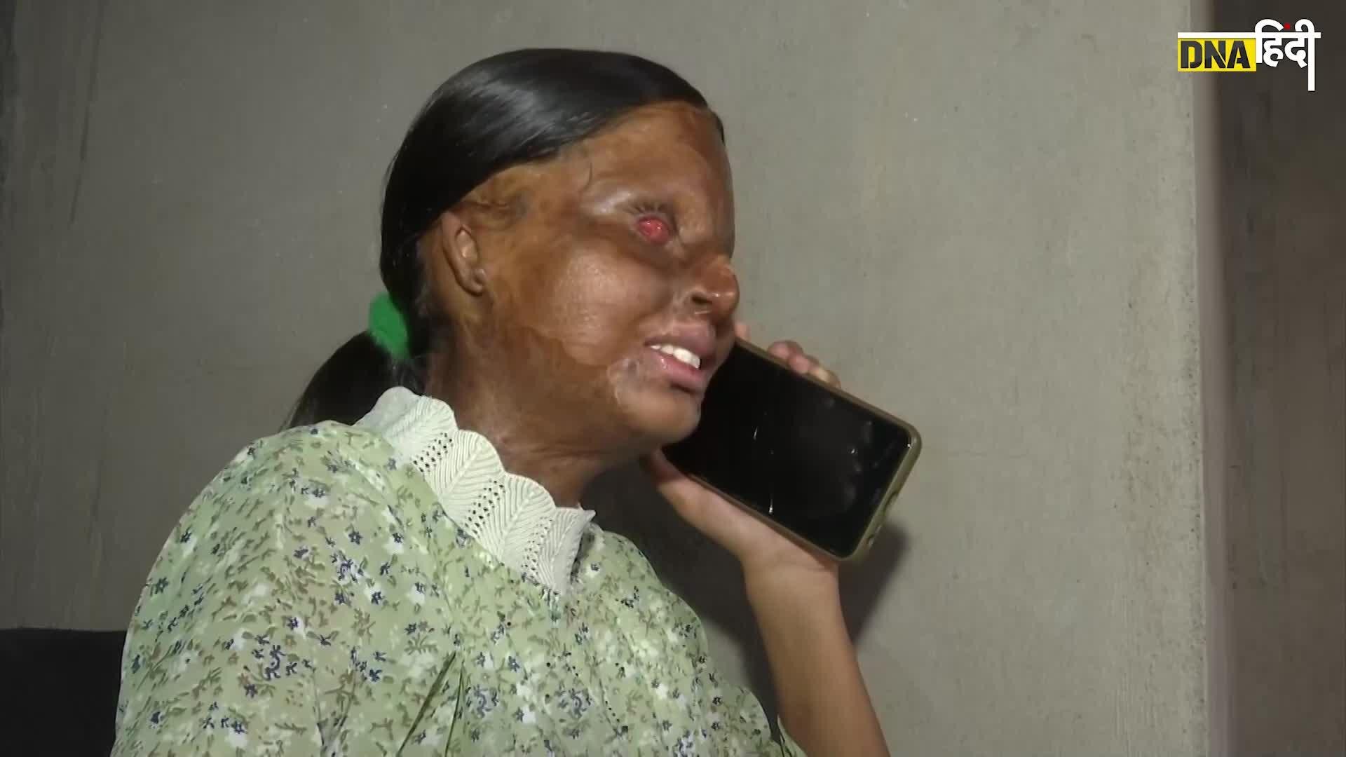 Video: CBSE Result- Acid Attack की वजह से गंवाई आखों की रोशनी, अब CBSE 10वीं में टॉप करके पेश किया मिसाल