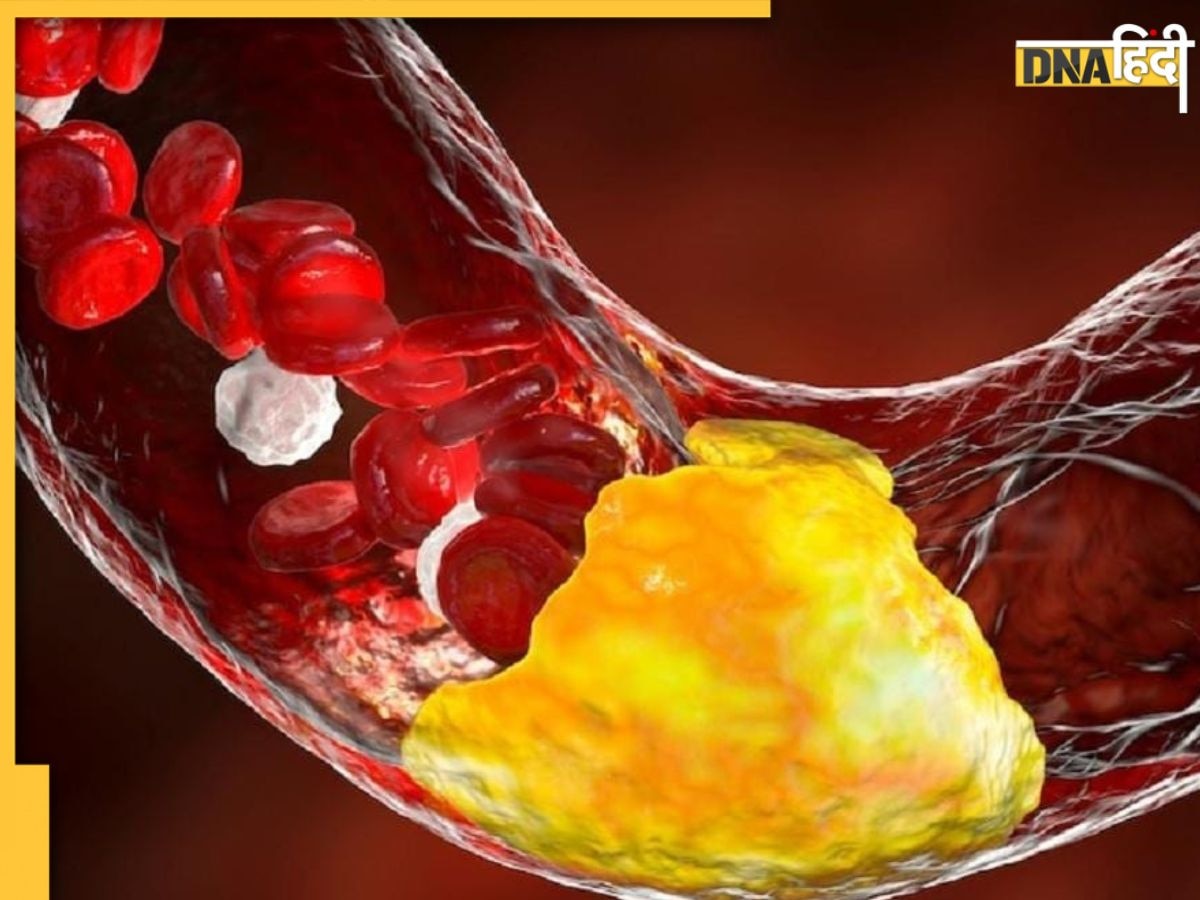 Cholesterol Sign: आंख-पैर-जीभ में दिखने लगे ये संकेत तो समझ लें ब्लड और नसों में बुरी तरह से जमने लगा है गंदा कोलेस्ट्रॉल 