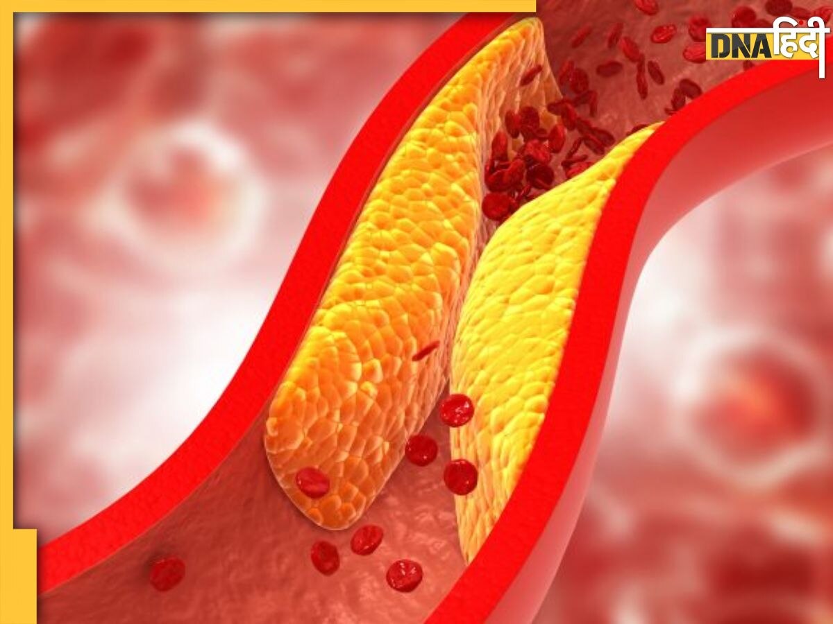 Cholesterol Reduce Remedy: हाई कोलेस्ट्रॉल के मरीज अपना लें ये 3 घरेलू उपाय, नसों से बाहर हो जाएगा चिपचिपा पदार्थ, नहीं रहेगा Bad Cholesterol