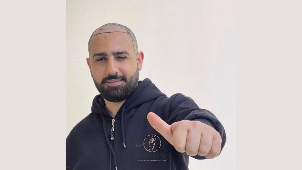 Affordable Hair Transplant Clinic in Surat - Best Class Treatment | NHT