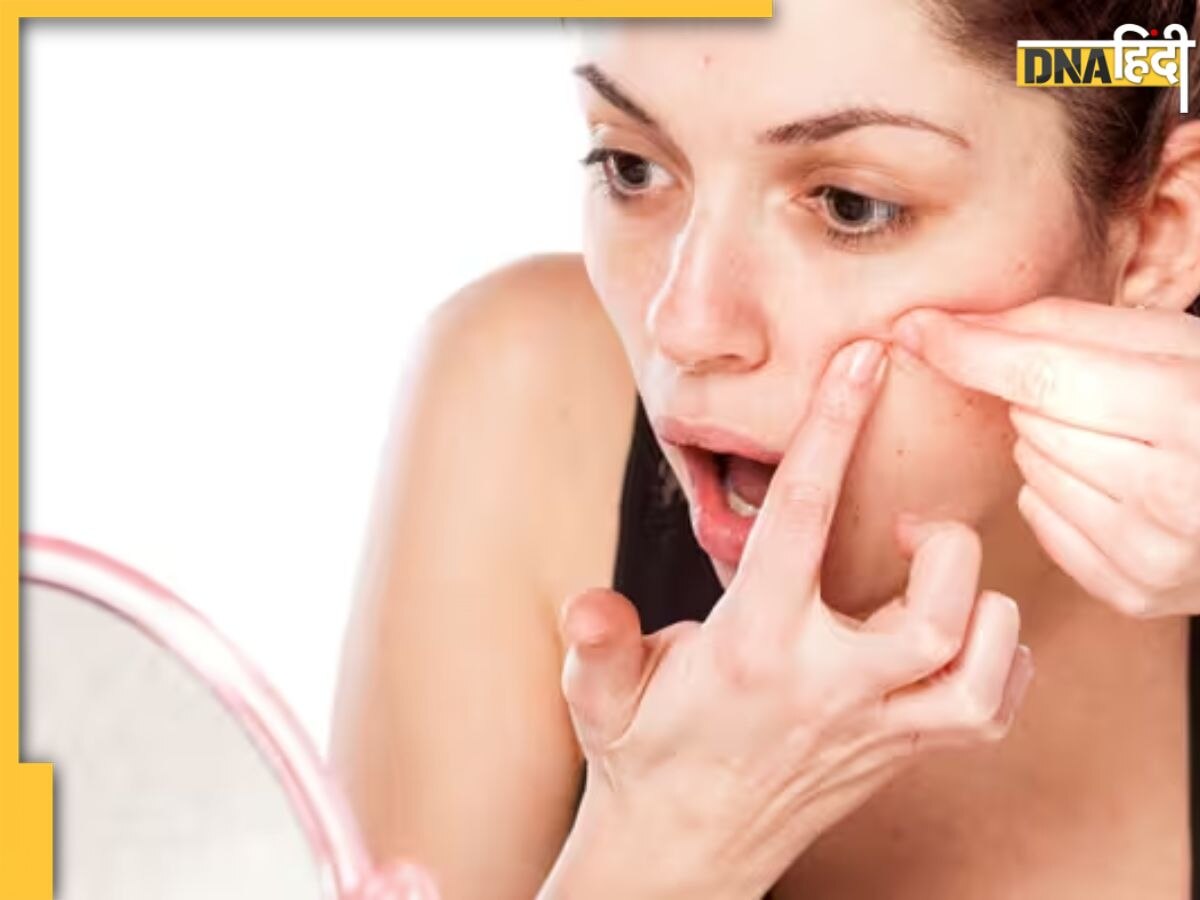 Acne Free, ग्लोइंग स्किन के लिए गुलाब जल के साथ मिलाकर लगाएं ये एक चीज, हफ्ते भर में दिखने लगेगा असर