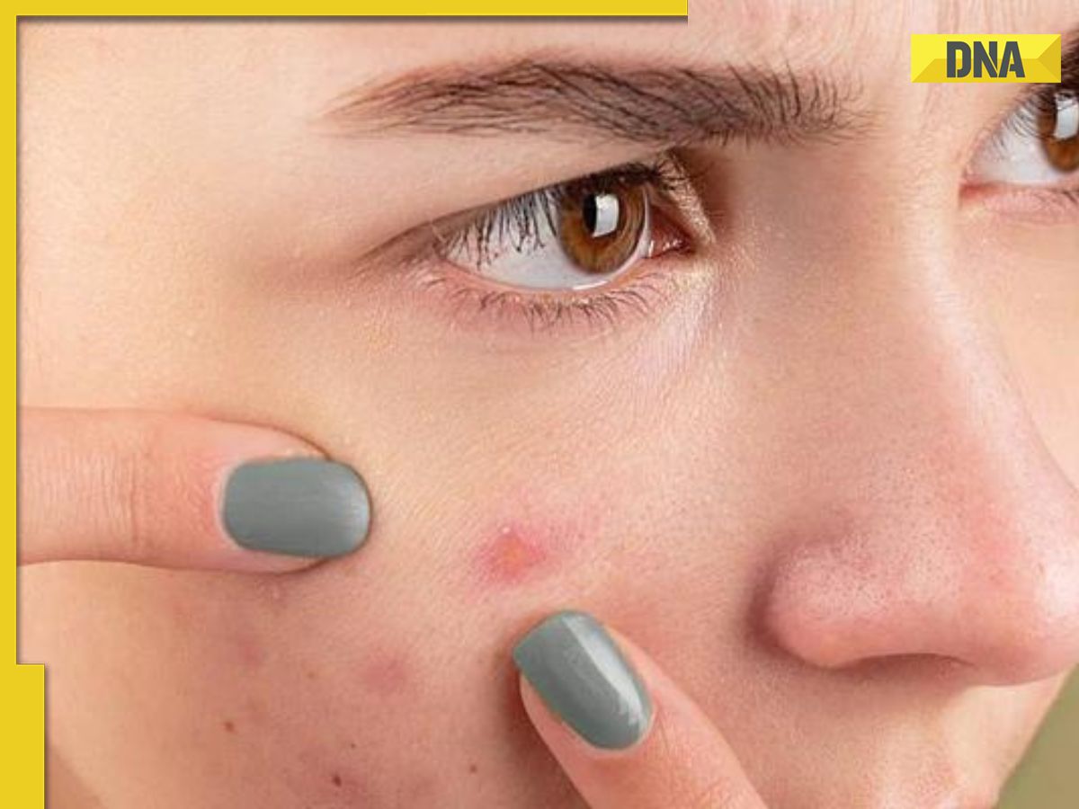 Do you get pimples after eating mangoes? Here's how to prevent