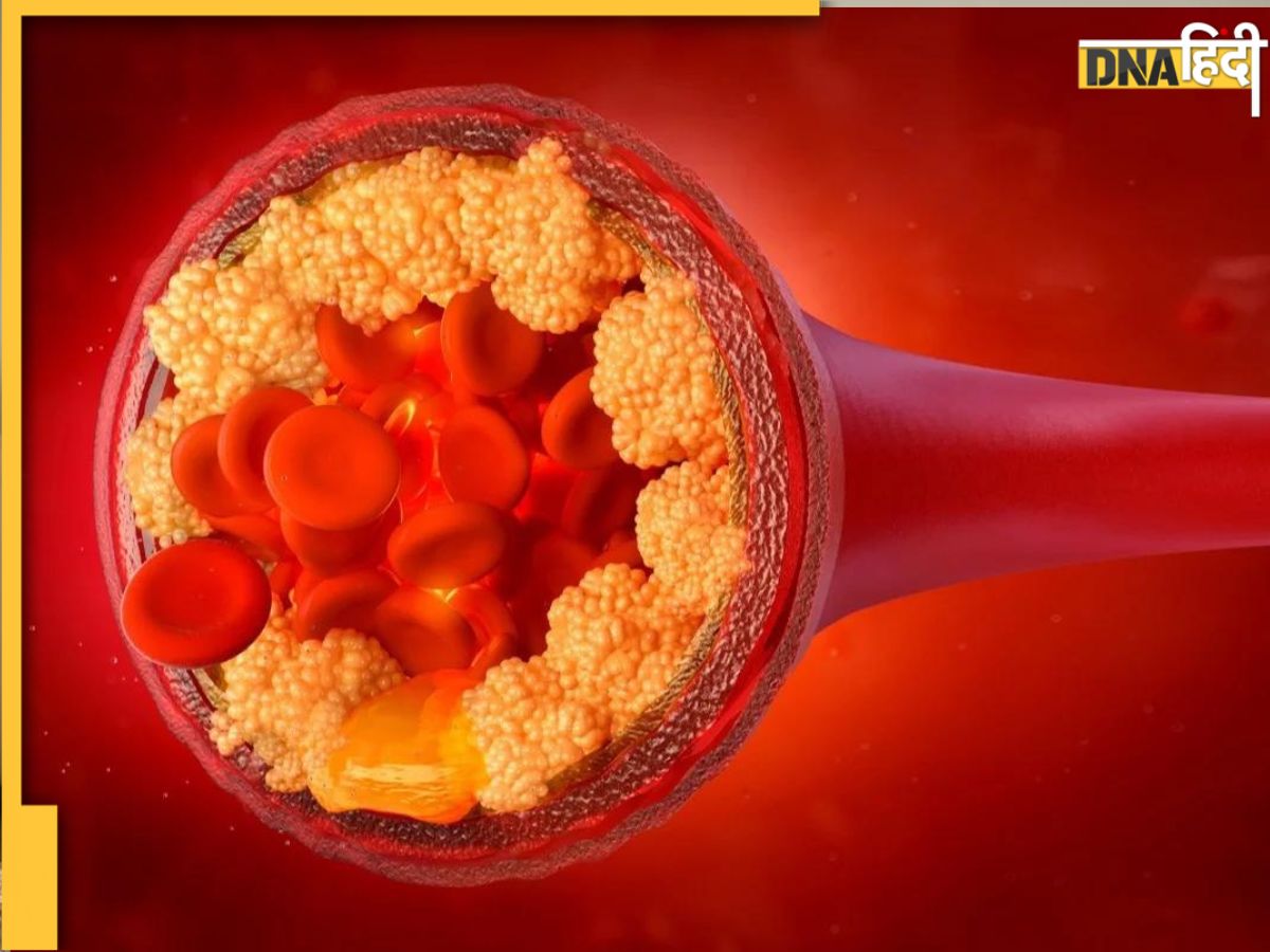 Cholesterol Alert इस 5 वजहों से खून से लेकर नसों तक में भर जाएगा गंदा कोलेस्ट्रॉल वेन्स 0607