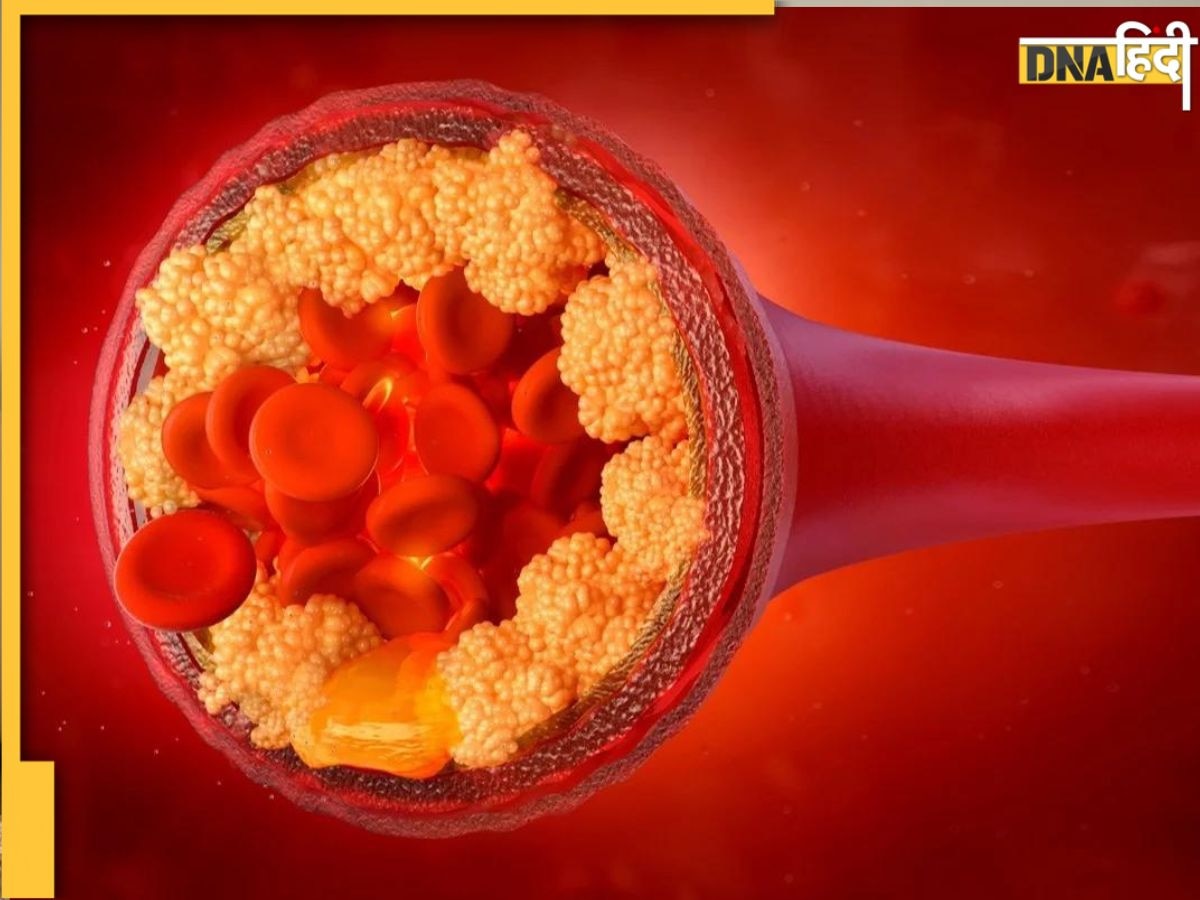 Cholesterol Alert: इस 5 वजहों से खून से लेकर नसों तक में भर जाएगा गंदा कोलेस्ट्रॉल, वेन्स ब्लॉकेज से बढ़ेगा हार्ट अटैक का खतर�ा