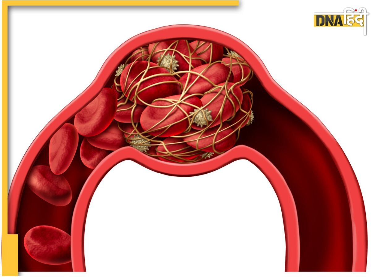 Blood Clotting Dangerous Sign: ये 4 संकेत बताते हैं फेफड़ों तक पहुंच सकती है ब्लड में बन रही क्लॉटिंग