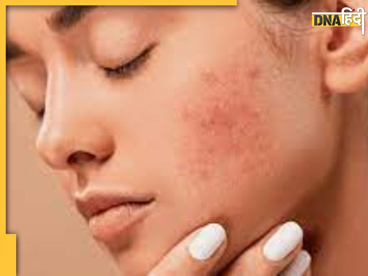 Babool Bark Skin Care: स्किन से जुड़ी इन 3 समस्याओं को खत्म कर देगी पेड़ की छाल, जानें इस्तेमाल करने का तरीका और फायदे