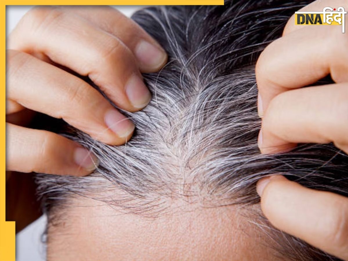 White Hair Remedies: कम उम्र में सफेद हो गए हैं बाल, इन आयुर्वेदिक उपायों से करें काला, टूटना और झड़ना भी हो जाएगा बंद