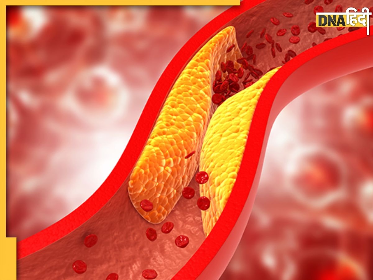 High Cholesterol Signs: धमनियों में जमा चिपचिपा पदार्थ बढ़ा देता है हार्ट अटैक का खतरा, इन लक्षणों के दिखते ही हो जाएं अलर्ट