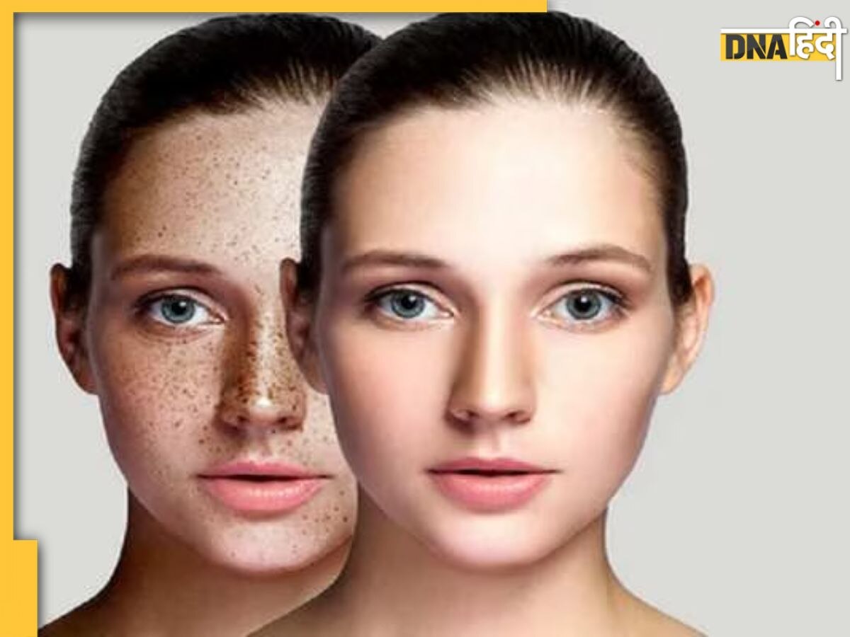 Dark Spots Caues: चेहरे पर पिंपल्स और दाग-धब्बों की वजह बनती हैं आपकी ये बुरी आदतें, तुरंत कर लें सुधार