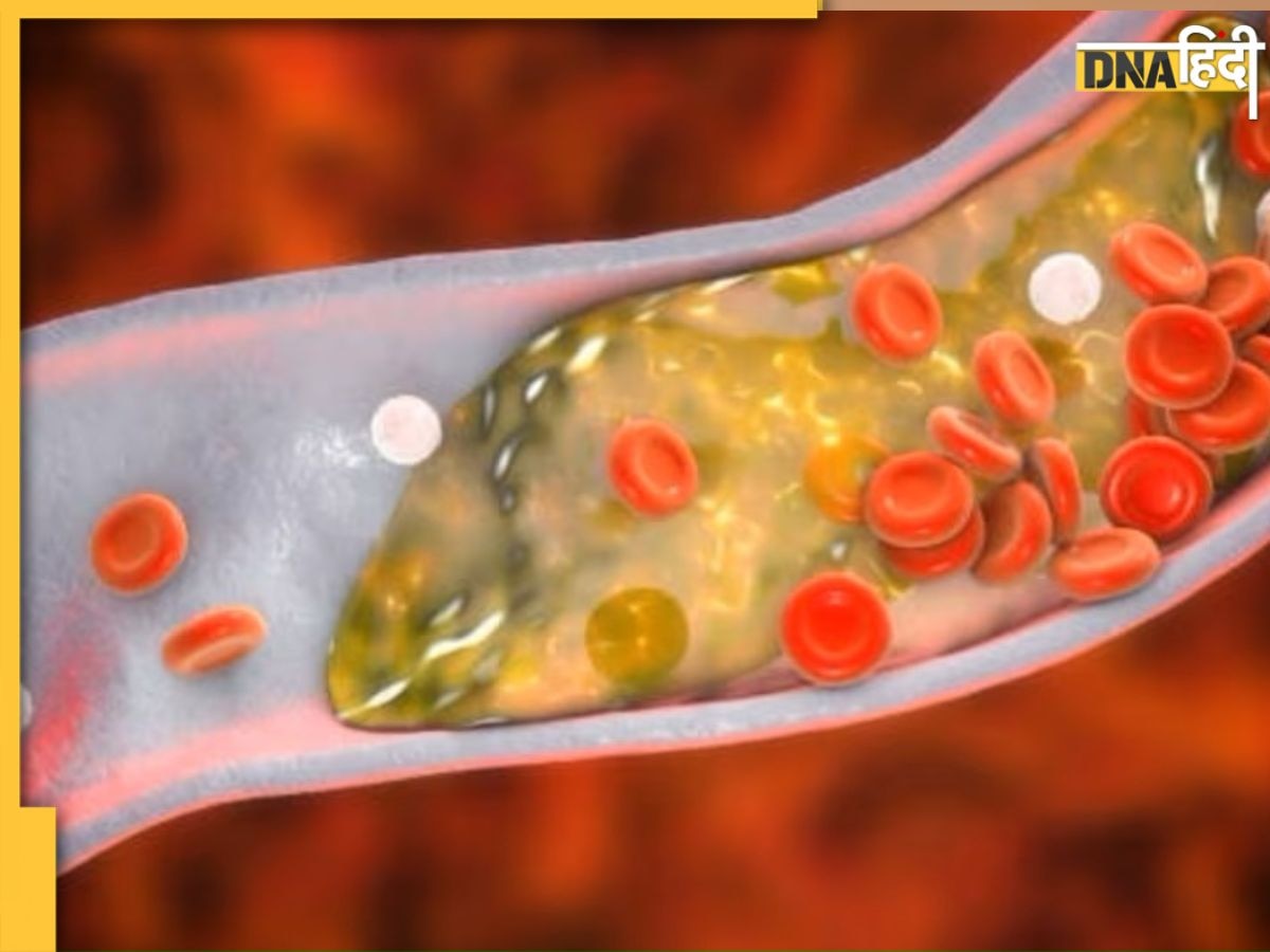 नसों को ब्लॉक करने से पहले कोलेस्ट्रॉल को बाहर कर देगी ये 2 रुपये की दवा, हेल्दी रहेगा हार्ट