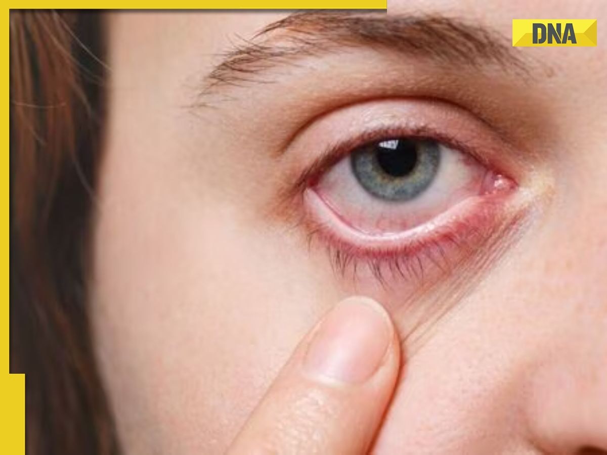 Conjunctivitis cases rise in Delhi-NCR: How does pink eye spread; prevention tips