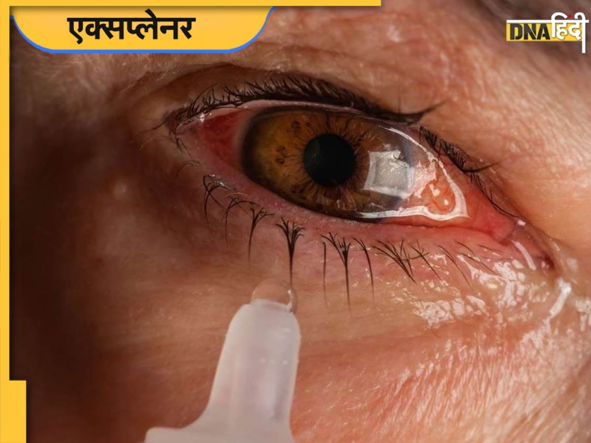 Eye Flu के बारे में सबकुछ जो आप जानना चाहते हैं