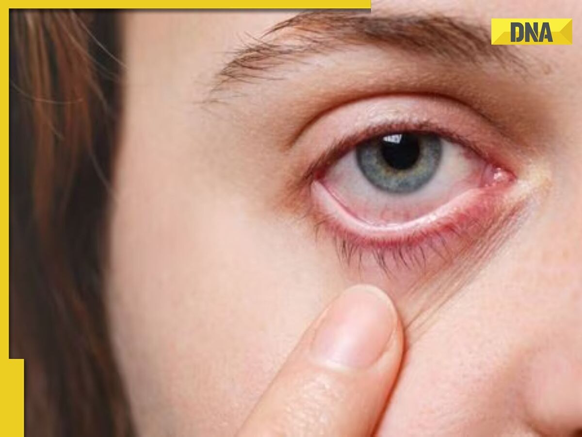 Conjunctivitis alert: 6 warning signs you should never ignore