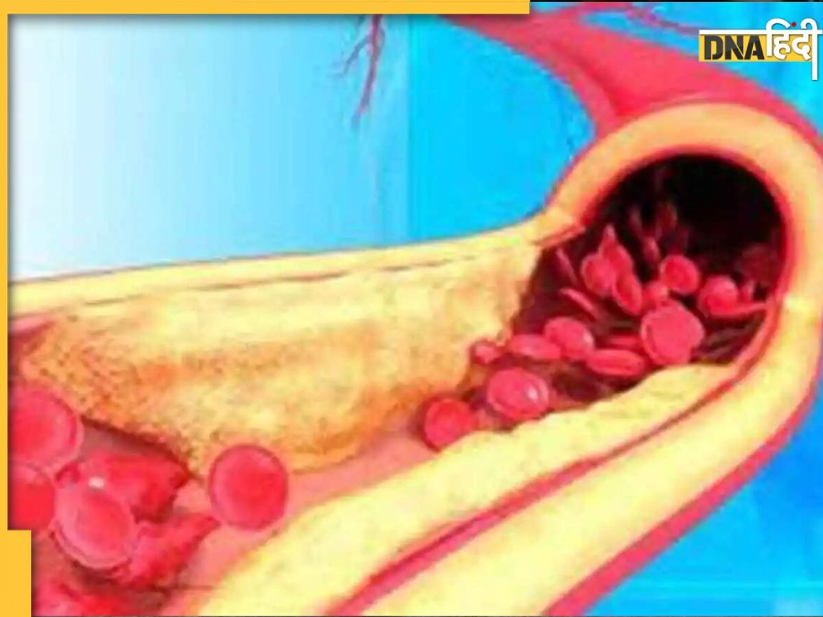 Cholesterol Remedy: अचानक कोलेस्ट्रॉल बढ़ने पर सुबह खाली पेट निगल लें ये एक चीज, नसों तुरंत पिघल जाएगी वसा